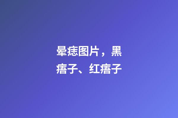 晕痣图片，黑痦子、红痦子-第1张-观点-玄机派